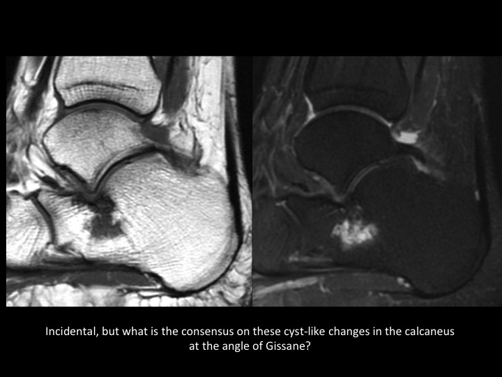Figure 5 for case talocalcaneal joint ( RID3030 )